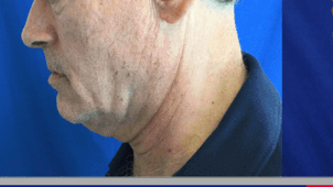 Dr Suzman Neck LIft